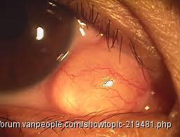 第一次看到人家眼白的部份腫起來 欢乐灌水 人在温哥华vanpeople Com